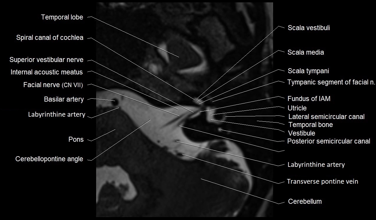 Internal auditory canal (IAC) axial cross sectional anatomy image 14.webp